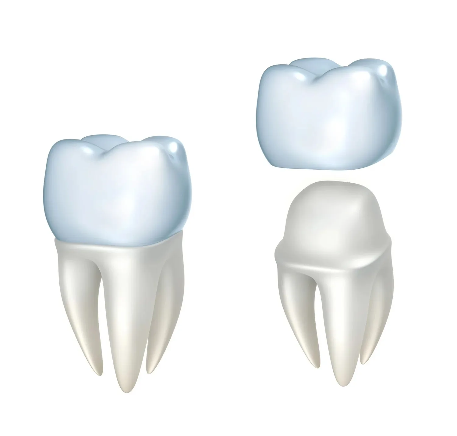 Dental crown fitted onto a tooth alongside a crown separated from a prepared tooth.